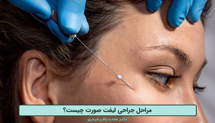 مراحل جراحی لیفت صورت