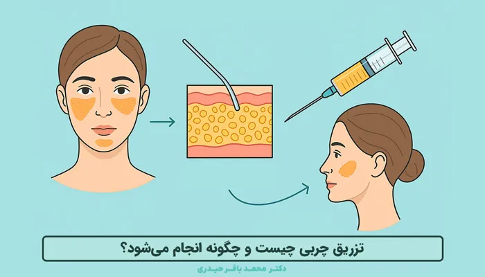 مراحل تزریق چربی به صورت و بدن