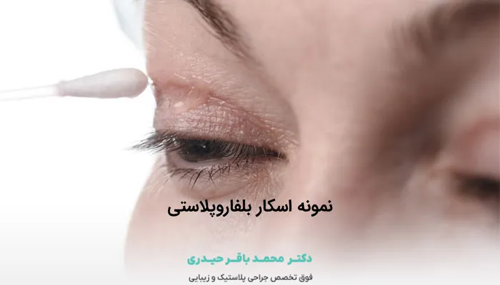 نمونه زخم عمل لیفت پلک
