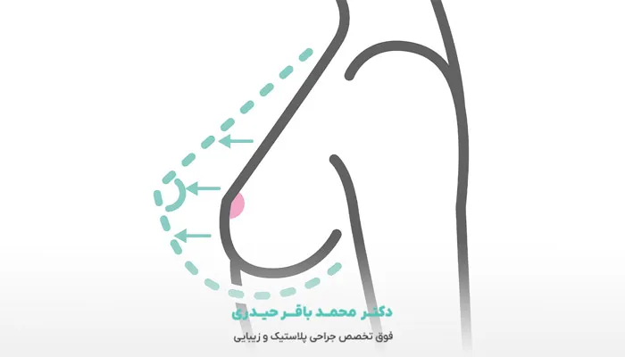 هزینه ماموپلاستی چقدر است؟