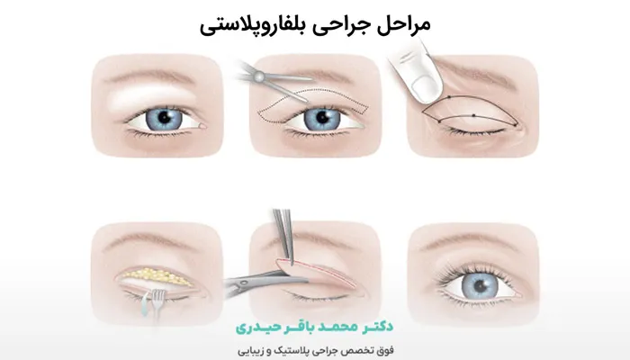 مراحل جراحی پلک به چه صورت است؟
