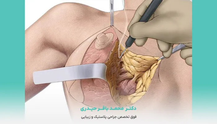 تصویر انیمیشینی جراحی ماموپلاستی