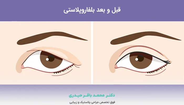 قبل و بعد جراحی پلک