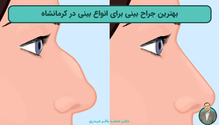 بهترین جراح برای انواع بینی