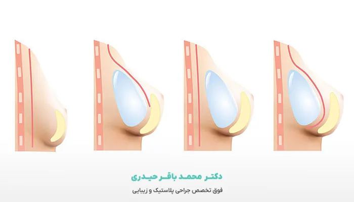 ماموپلاستی افزایشی با پروتز