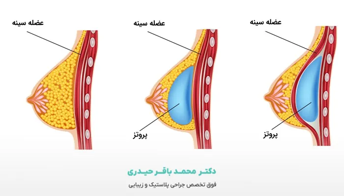 مراحل ماموپلاستی