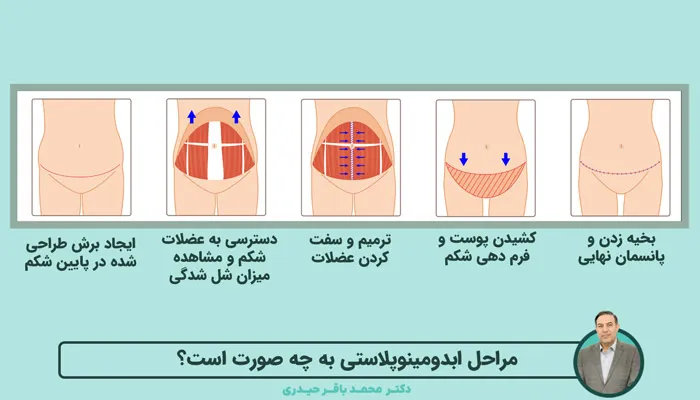 مراحل جراحی زیبایی شکم (ابدومینوپلاستی)