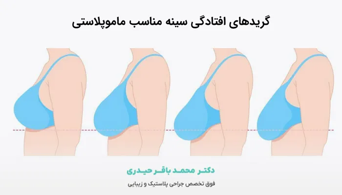 گریدهای افتادگی سینه