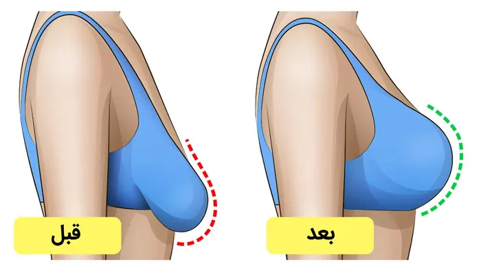 ترکیب ماموپلاستی و لیفت سینه